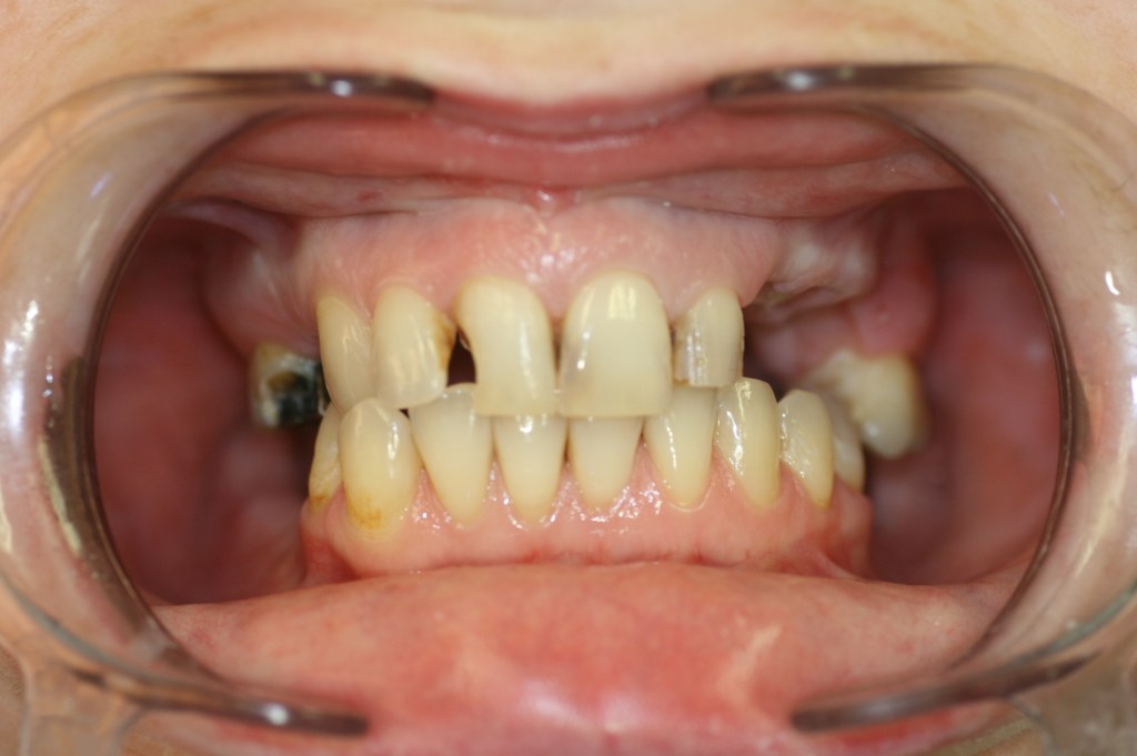 Patient's mouth before veneers