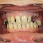 Patient's mouth before veneers