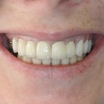 Patient's smile after veneers