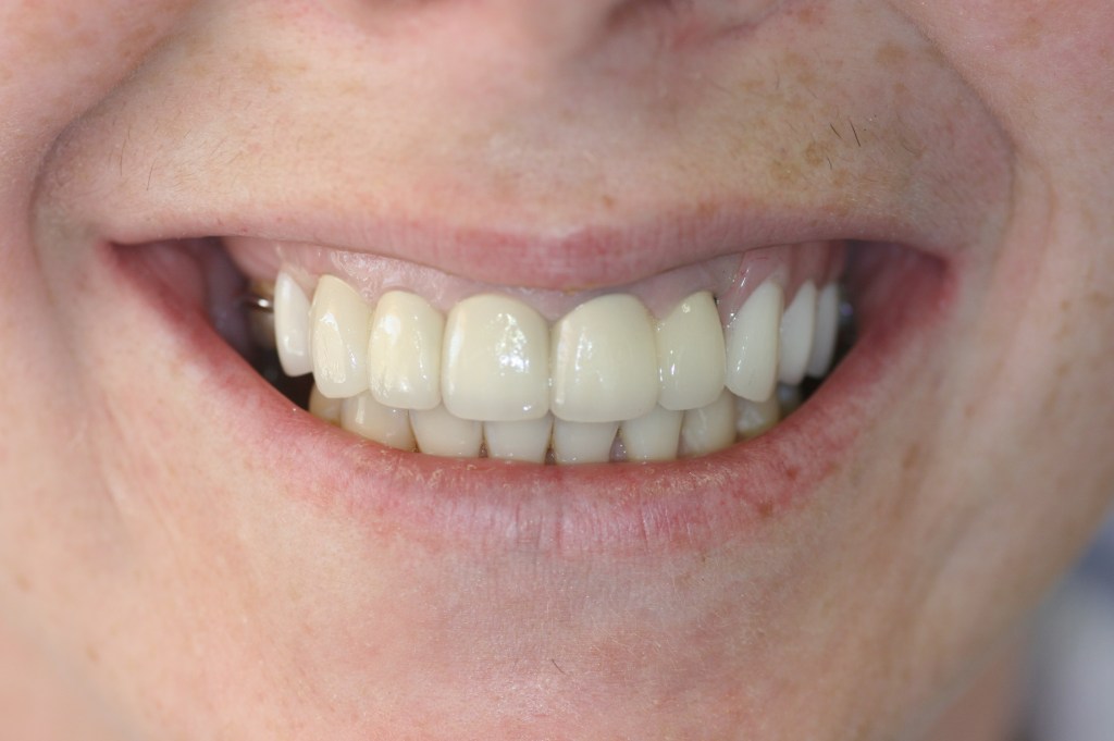 Patient's smile after veneers