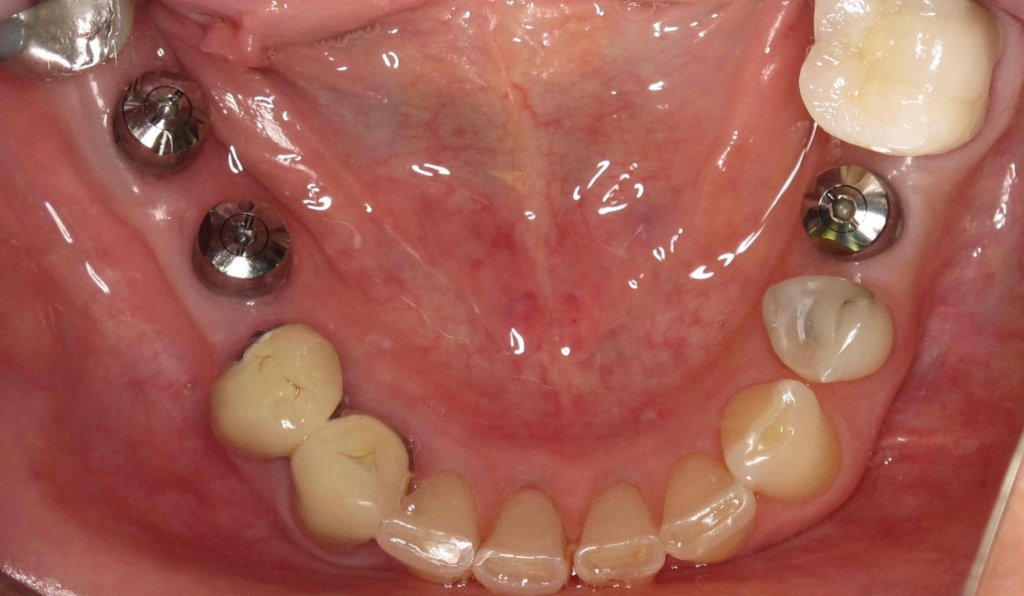 Patient's lower teeth with placed dental implants