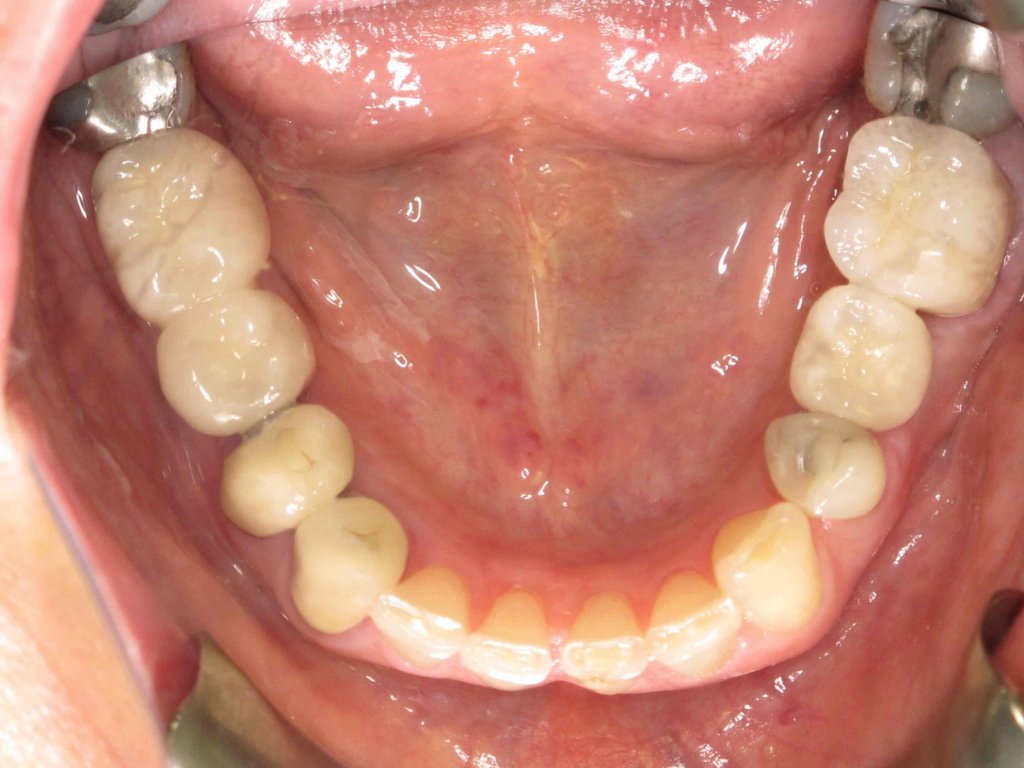 Patient's lower teeth with crowned dental implants
