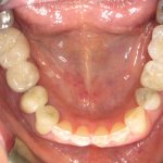 Patient's lower teeth with crowned dental implants