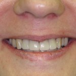 Patient's smile after dental implants