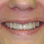 Patient's smile after dental implants