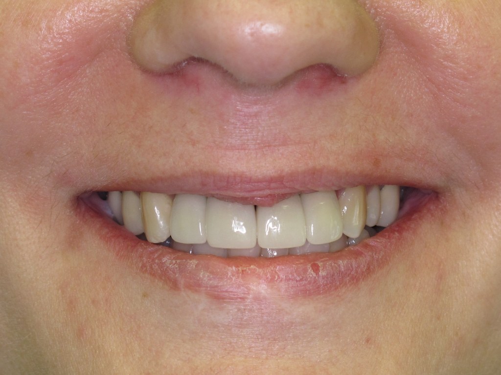 Patient's smile after dental implants