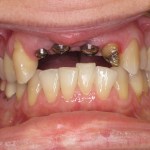 Patient's mouth with placed dental implants