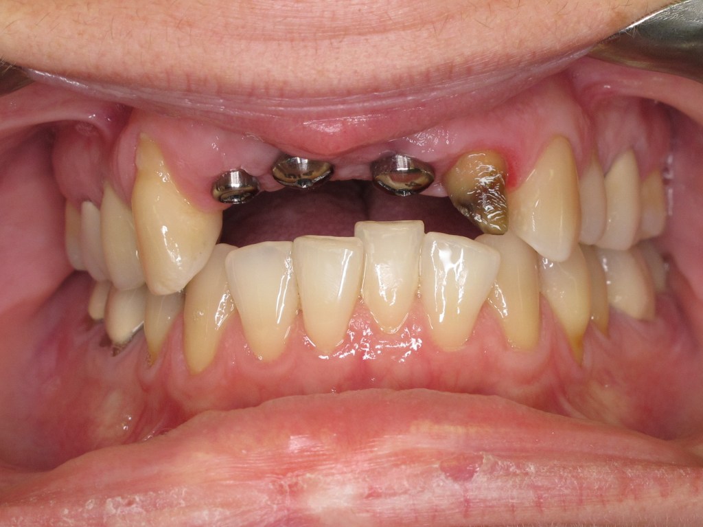 Patient's mouth with placed dental implants