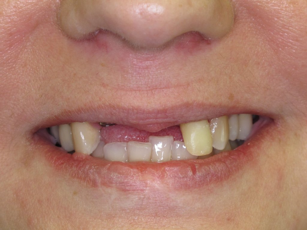 Patient's smile before dental implants