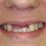 Patient's smile before dental implants