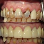 Patient's smile before and after treatment